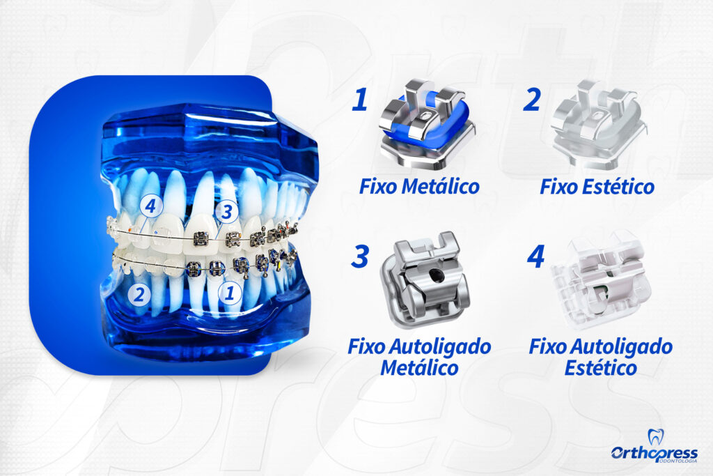 Tipos de aparelhos ortodônticos